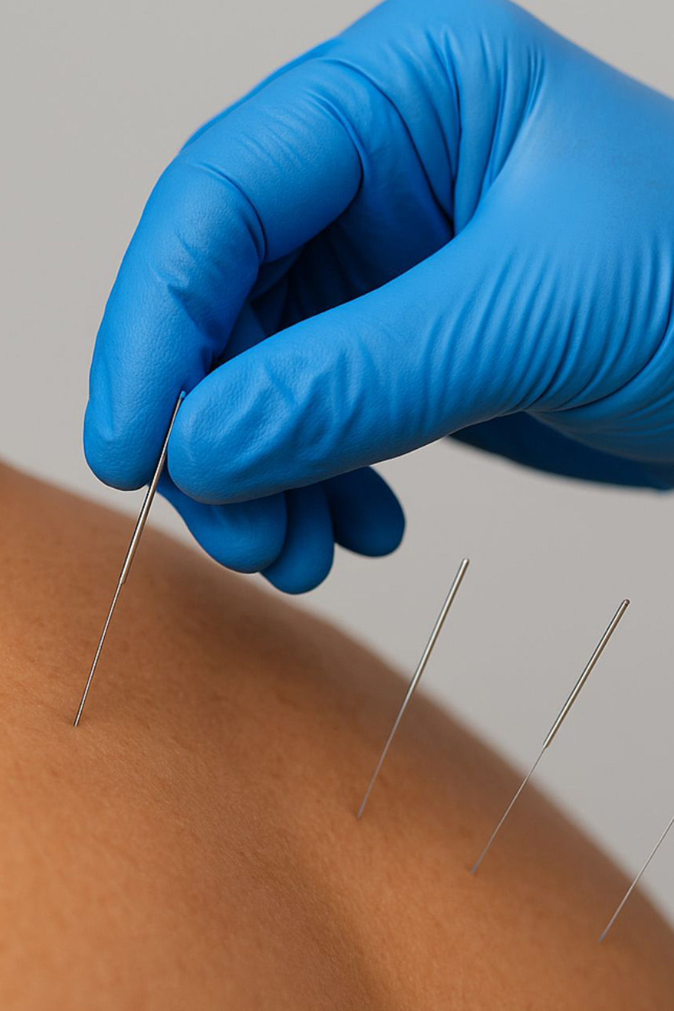 dry needling Therapy